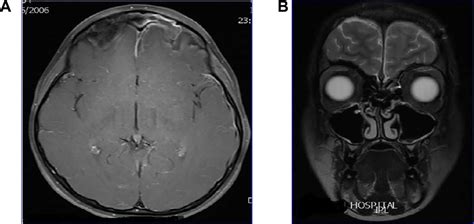 can a sinus infection lead to meningitis